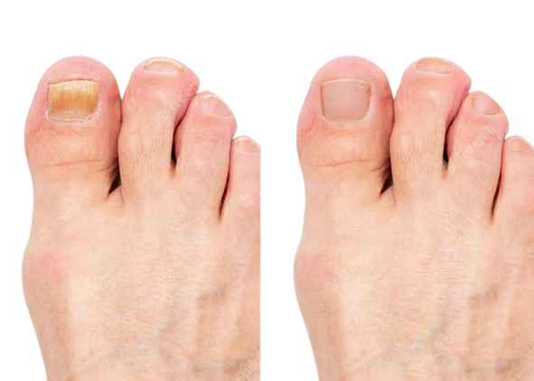 Neoclear Antifungal Device Before and After